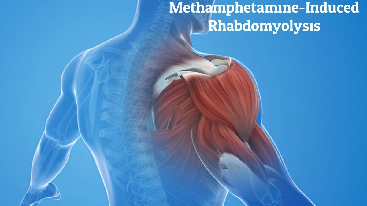 Methamphetamine-Induced Rhabdomyolysis – Effects