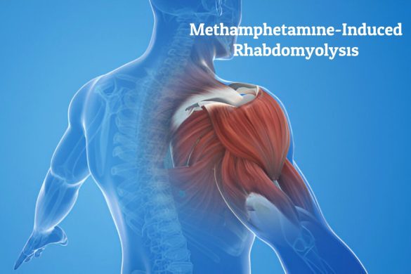 Methamphetamine-Induced Rhabdomyolysis